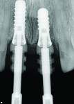 Fig 8. Radiograph confirms the correct position of the impression copings for taking the impression.