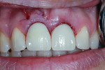 Fig 7. Image depicts the view of the new provisional restorations for teeth No. 8 and No. 9.