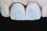 Fig 15. In the laboratory, the color of the IPS e.max lithium disilicate restorations was modified.