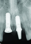 Fig 6. Radiograph following and confirming implant placement.
