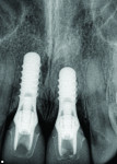 Fig 11. Radiograph of the IPS e.max abutments to verify fit.