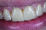 Fig 16. Natural smile view of the patient with the definitive implant supported IPS e.max lithium disilicate restorations.