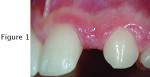 A preoperative clinical image. Image provided by Petrungaro P. Management of compromised intertooth spaces using small-diameter implants. Inside Dentistry. 2014;10(9):90-95.