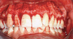 Figure 1 Alveolar corticotomy with conventional surgical approach. Buccal and lingual full-thickness flap elevation followed by cortical incisions using a round bur.