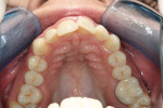 Figure 2C  Upper and lower occlusal views pretreatment; 6-mm ante- rior crowding is visible.