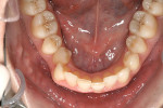 Figure 2D Upper and lower occlusal views pretreatment; 6-mm antrior crowding is visible.