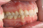 Figure 2E Pretreatment intraoral photo- graph, right side, showing an end-on canine class II division II dental relationship.