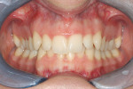 Figure 2F Pretreatment frontal intra- oral photograph showing the patient’s deep bite (65%).