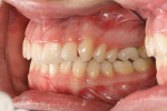 Figure 2G Pretreatment intraoral photograph, left side, showing an end-on canine class II division II dental relationship.