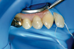 Figure 3  Preoperative view of tooth No. 5, which was previously treated with endodontic therapy.