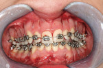 Figure 3G Frontal view at the completion of the surgical procedure. The vertical incisions between the canines and laterals and the central incisors are closed using a 5-0 chromic gut suture (Ethicon, Inc., Somerville, NJ). The other areas did not require suturing.