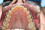 Figure 4A Upper and lower occlusal views 6 weeks posttreatment.