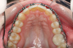 Figure 4C Upper and lower occlusal views 10 weeks posttreatment.