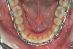 Figure 4D Upper and lower occlusal views 10 weeks posttreatment.