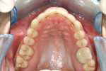 Figure 4E Upper and lower occlusal views 17 weeks posttreatment.