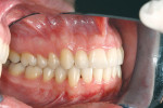 Figure 4G Posttreatment intraoral photograph, right side; class I relationship was achieved, and the overjet was reduced to an ideal 1 mm.