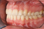 Figure 4I Posttreatment intraoral photo- graph, left side; class I relationship was achieved, and the overjet was reduced to an ideal 1 mm.