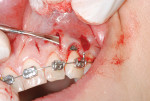 Figure 5A Another patient presenting with a recession of 3 mm on tooth No. 11. In this case, Piezocision was combined with soft-tissue grafting. The area is tunneled, creating space for connective tissue grafting.