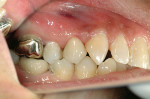 Figure 6  Postoperative view of the final restoration. Note the esthetic integration.