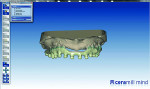 Fig 5 and Fig 6. The uploaded wax setup can be used to help design proper retention for the teeth and acrylic.