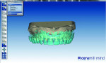 Fig 5 and Fig 6. The uploaded wax setup can be used to help design proper retention for the teeth and acrylic.
