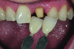 Fig 1. Clinician and technician used custom shade tabs to choose enamel and translucency.