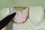 Fig 8. Dentin was layered over the substructure body.