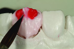 Fig 9. Mamelons were built over the dentin.