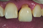 Fig 16. Gingival margin to incisal proportion was assessed at the try-in.