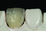Fig 13. Mesial shape and contact were assessed.
