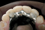 Figure 3  An occlusal view of the partial in place. Compare this view with the wax-up design.