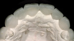 Figure 4  An occlusal view of the wax-up design with index putty making the proposed size corrections.