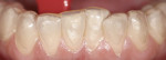 Examples of precisely fabricated upper and lower KöR-Seal Whitening Trays.