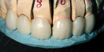 Figure 11  After firing, index putty checked for incisal room.