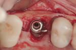 A full-thickness flap was elevated, enabling visualization of the hopeless implant.