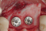 A dermal allograft was trimmed and adapted over the buccal and palatal cortical plates.