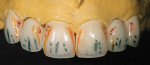 Figure 14  The contour was finished with glaze. Orange and black marks on the crowns indicated where to create lobe or a secondary convex/concave shape to mimic natural teeth.