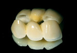 Figure 15  One of the 3-unit zirconia bridges completed (shown with mirrored image).
