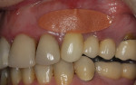 Figure 1 PerioPatch device applied to the gingiva after scaling and root planing as an adjunctive therapy to reduce the inflammatory burden.