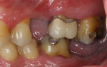 Figure 5 Case 1, intraoral image of treatment sites Nos. 14 and 15 (pretreatment).