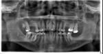 Figure 4 Case 1, 60-year-old white male, panoramic radiograph.