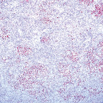 Figure 3 Epstein-Barr virus–encoded RNA (EBER) in situ hybridization is strongly positive as evidenced by the red dot-like nuclear staining (magnification 200x).