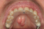 Figure 6 The immediate deprogrammer in place after intraoral fabrication.