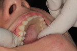 Figure 14 After reaching the contralateral molar, any excess material is pinched off.