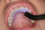 Figure 15 Light-curing with an intraoral curing light is performed until the material is initially set.