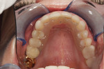 Figure 19 The final deprogrammer with one spot of occlusal contact.