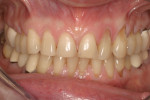 Figure 5 Retracted close-up view of the preoperative dentition.