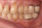 Figure 4 The preoperative view of the left side in MIP showed deteriorating restorations and erosion.