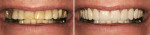 Figure 6  This patient had some discolored teeth and a lot of wear to the dentition. The patient wanted to see a more youthful smile with whiter and longer teeth. Image courtesy of Virtual Smiles.