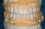 Wax-up demonstrating diastemata closure.